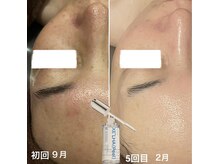 ロージースマイル(Rosy smile)の雰囲気（『セラピール』美容乳酸菌のチカラでくすみ・毛穴・キメ・透明感）