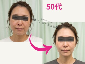 チャラク(charaku)/【50代I様：小顔矯正+光フォト】