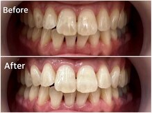 アスティ(ASTY)/歯のセルフホワイトニング