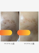 アメイジングボディーワクス(Amazing Body Works)/マツヤニ美肌ワックス　シミ