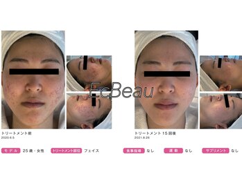 エクボ(EcBeau)/水光ピーリング