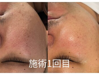 デン(DEN)/プラズマニア【1回でこの効果】