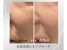 サラ(SARAH)の雰囲気（1回で実感！シミやくすみにもアプローチ！毛穴まで目立たなく♪）