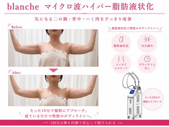 オリエンタルローザ 表参道(Oriental Rosa)/マイクロ波ハイパー脂肪液化術！