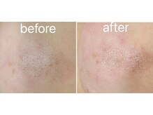 トータルビューティーサロン ナーズ(NAZ)/ハイドロピーリング毛穴洗浄