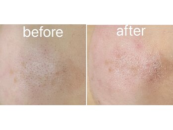 トータルビューティーサロン ナーズ(NAZ)/ハイドロピーリング毛穴洗浄