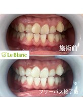 ルブラン 奈良店(Le Blanc)/ホワイトニングで垢抜け！
