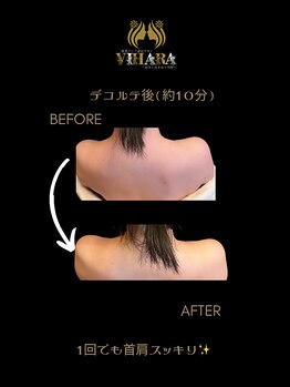 ビハーラ 門司店/リンパマッサージで巻き肩改善