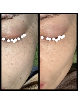 ココスタイルビューティー(COCOSTYLE beauty)/シミケア