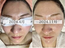 エクレ(eclat)/最先端韓国ピーリング