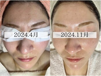 エクレ(eclat)/最先端韓国ピーリング