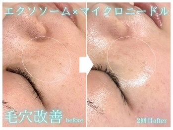 ラ ドゥーサ(La Dusa)/頬の開き毛穴に効果エクソソーム