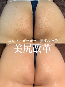 ルアナアイナ(Luana Aina)/お尻ケア/ハーブピーリング