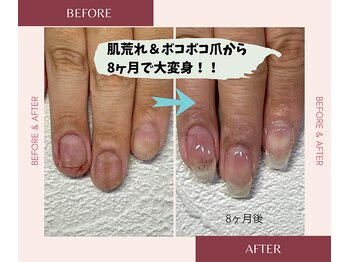 ブルームブルーム(BLOOMブルーム)/指周りの肌荒れ&ボコボコ爪