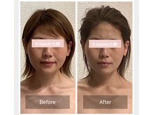 ケービューティー 小顔(K-beauty)の雰囲気（オールハンドのコルギ施術　before after）