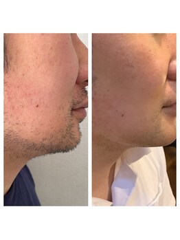 アイチューズ(ICHOOSE)/ヒゲ脱毛10回！