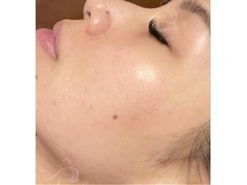 リベル 名古屋(Lebelle:)/ハーブピーリング専門名古屋