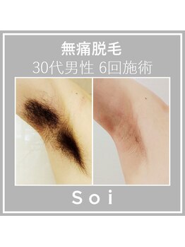 ソイ(Soi)/30代男性/ワキ脱毛