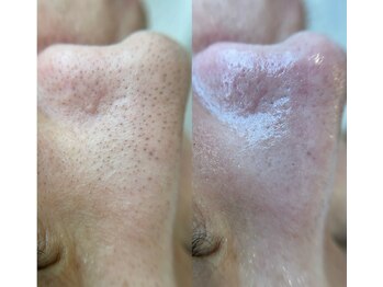 メリア(Mellia)/韓国式3D毛穴洗浄