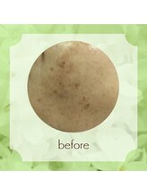 ビューティフィーサロン ベルル(Belulu)/シミケア+オーダーFビフォー