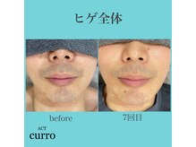 アクト クロ(ACT curro)/【ヒゲ全体】脱毛施術例