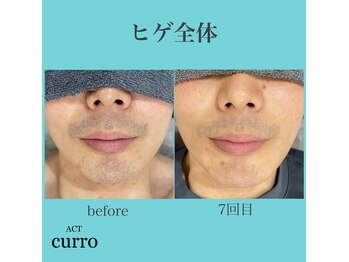 アクト クロ(ACT curro)/【ヒゲ全体】脱毛施術例