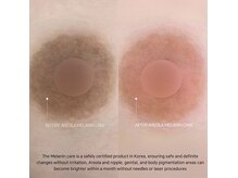 針もレーザーも使いません◎一回でしっかり変化します！