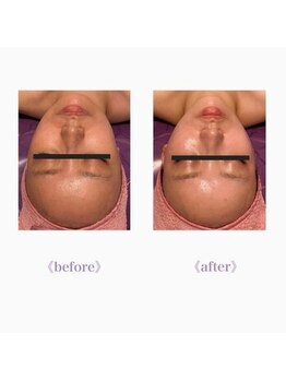 ライゼ(REISE)/ビフォーアフターご紹介(美白)