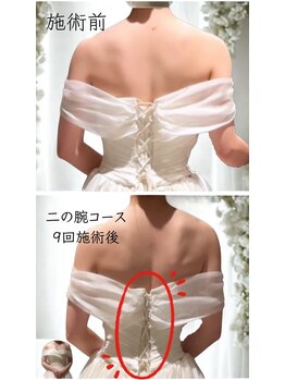 ルルン(LuLuN)/天使の羽二の腕スッキリコース