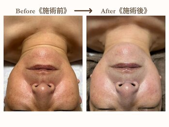 アラン(Aran)/《艶肌美白フェイシャル》