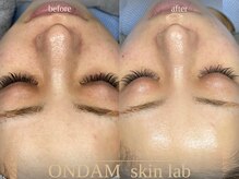 オンダム 表参道(ONDAM)/セラピールは敏感肌の方も施術◎