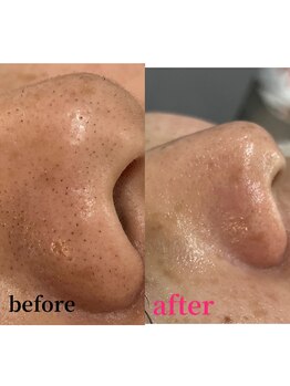 エリー(ERIE)/艶肌WAX × グローパック