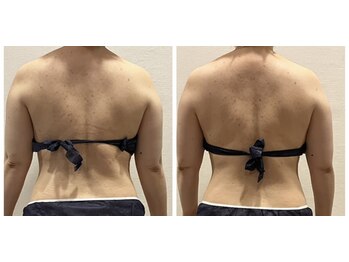 サロンサンティ/バザルト背中ウエスト＋キャビ