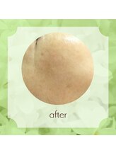 ビューティフィーサロン ベルル(Belulu)/シミケア+オーダーFアフター