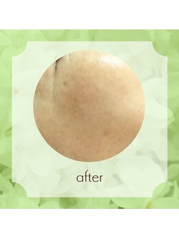 ビューティフィーサロン ベルル(Belulu)/シミケア+オーダーFアフター