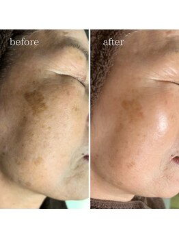 マーギアー(Magier)/ハーブ＋ダーマ　初来店→４回目