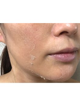 毛穴ケアをしたい