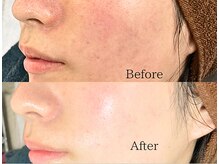 ミスティビオ 平尾店(mistyBIO)/《カサつき・肌荒れ》