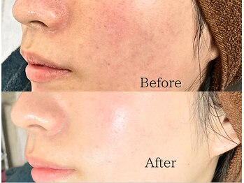 ミスティビオ 平尾店(mistyBIO)/《カサつき・肌荒れ》