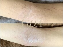 ヴィーダ 渋谷松濤(ViDA)/腕の肌質改善