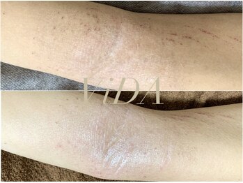 ヴィーダ 渋谷松濤(ViDA)/腕の肌質改善