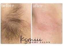 キスミー(Ksmiii)/脇/ワックス脱毛