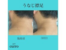 アクト クロ(ACT curro)/【うなじ襟足】脱毛施術例