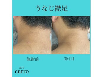 アクト クロ(ACT curro)/【うなじ襟足】脱毛施術例