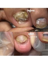 ネイルサロン ユーズ(USE.)/【トラブル爪ケア】フットケア