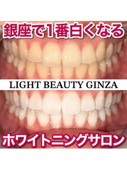 ライトビューティー 銀座店(LightBeauty)/東銀座 ホワイトニング 症例写真