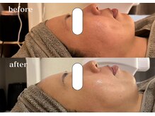 リスタ(RSTA)/【BEFORE/AFTER】