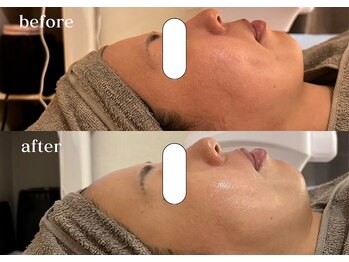 リスタ(RSTA)/【BEFORE/AFTER】