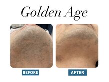 ゴールデンエイジ(Golden Age)/【ヒゲ脱毛】Before＆After