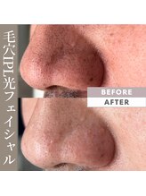 メロウ(mellow)/鼻の毛穴黒ずみに☆